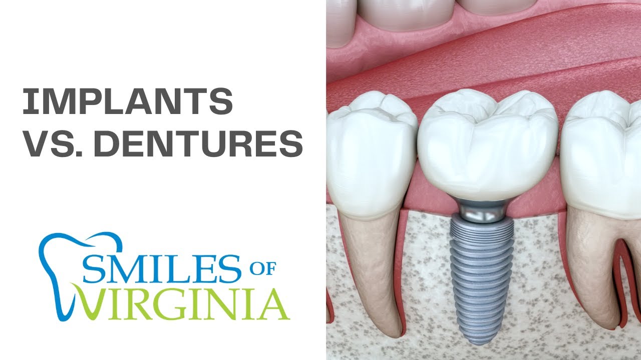 Dr. Oestervemb compares full-arch treatment paths — All-on-4 video