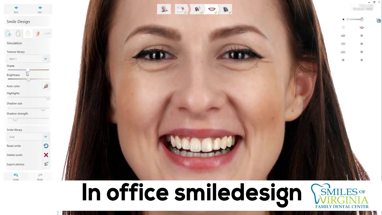 Single tooth implant explained by Dr. Oestervemb (video)