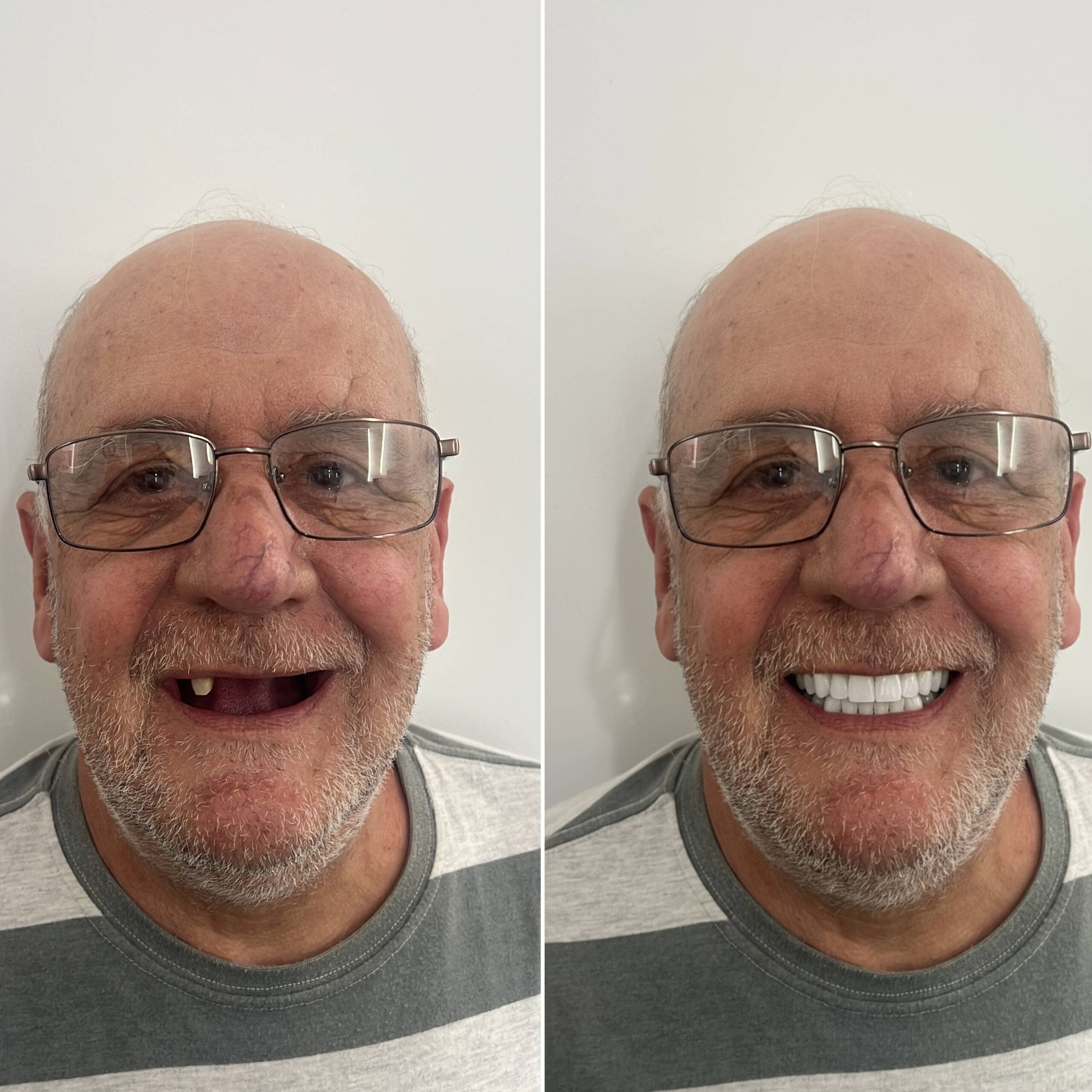 Example AI smile simulation before and after — All-on-X full-arch preview (representative Smile4D simulation)