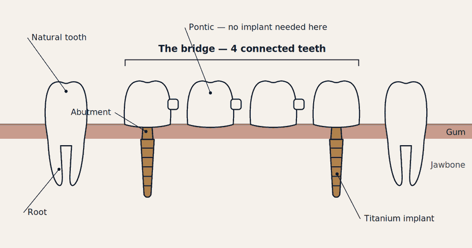 Labeled diagram of an implant bridge: four connected teeth supported by two titanium implants beside natural teeth with roots, shown in cross-section with gum and jawbone