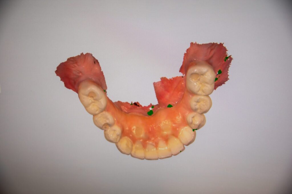 3D-printed scan of a temporary full-arch prosthesis made in the in-house lab at Winchester Dental Implant & Sedation Center