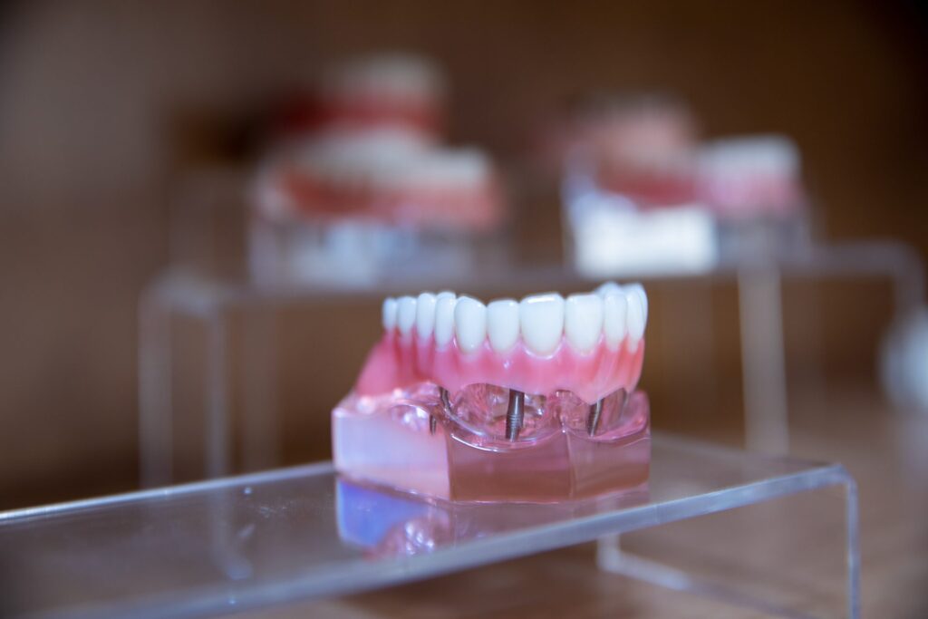 Educational model showing a snap-in implant overdenture supported by dental implants in the jaw