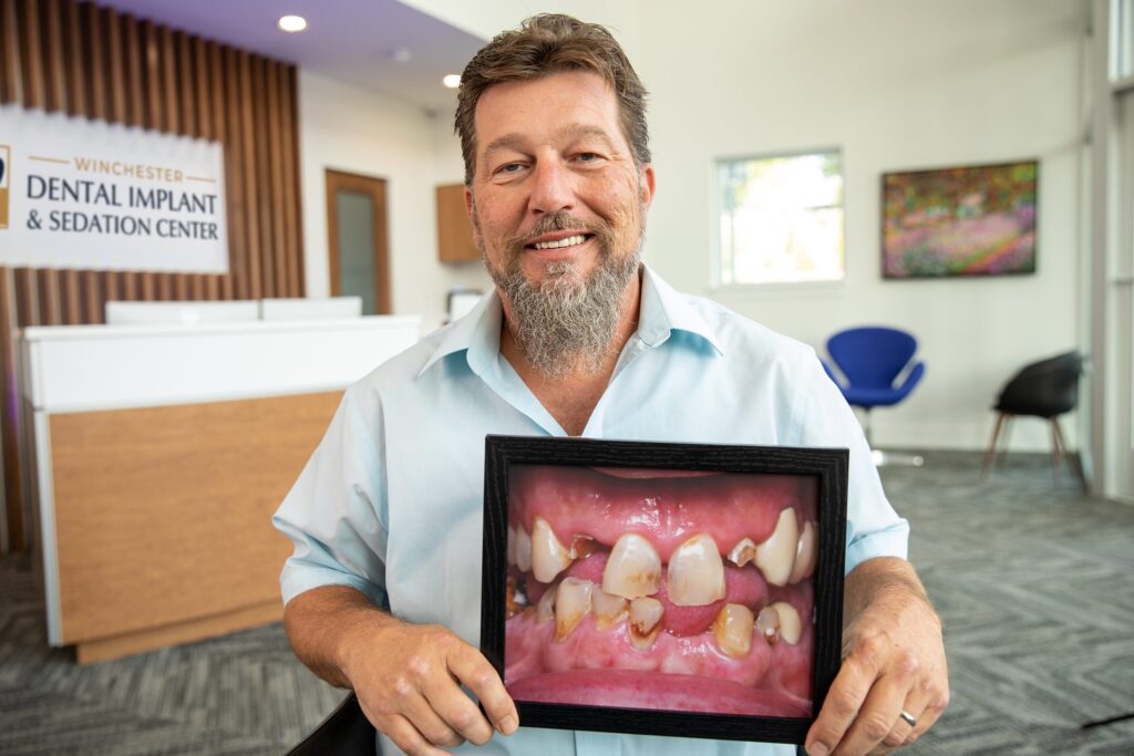 Upper All-on-4 dental implant patient holding a framed before photo of his worn and damaged teeth