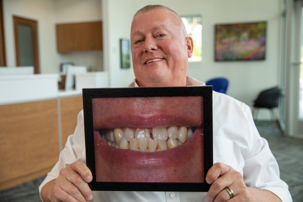 Upper All-on-4 patient showing his before photo next to his new smile